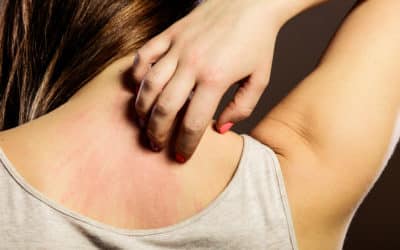 Dermatitis Atópica: causas, factores de riesgo y soluciones