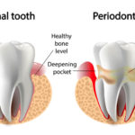 ¿Qué es y cómo tratar y prevenir la Periodontitis?