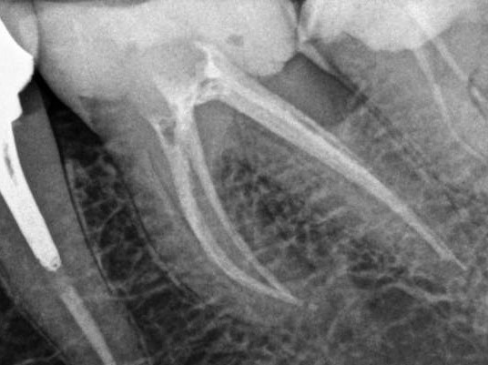 Radiografía diente con endodoncia