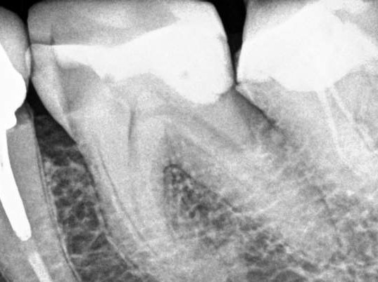 Radiografía diente sin endodoncia