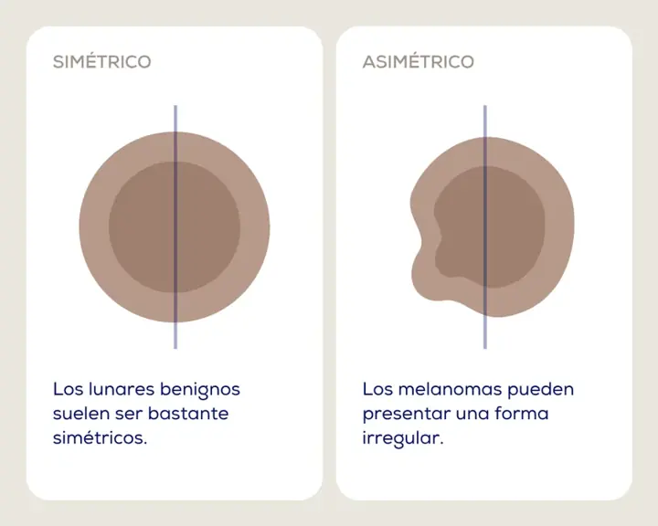 Regla ABCDE: lunar simétrico frente a lunar asimétrico