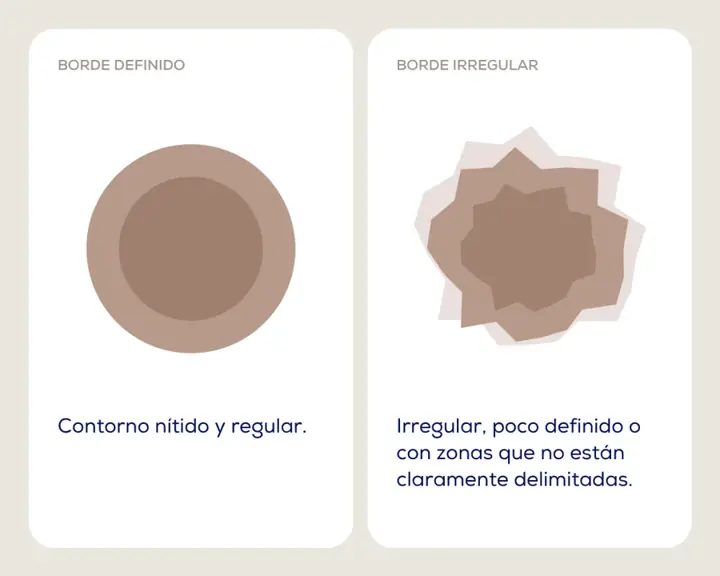 Regla ABCDE: lunar de borde definido frente a borde irregular