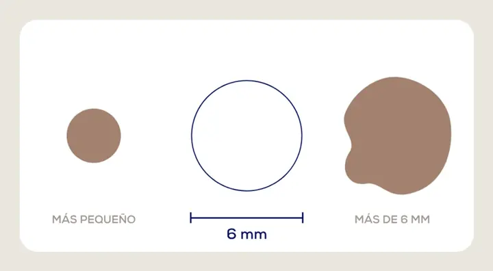 Regla ABCDE: diámetro de un lunar, referencia de 6 mm