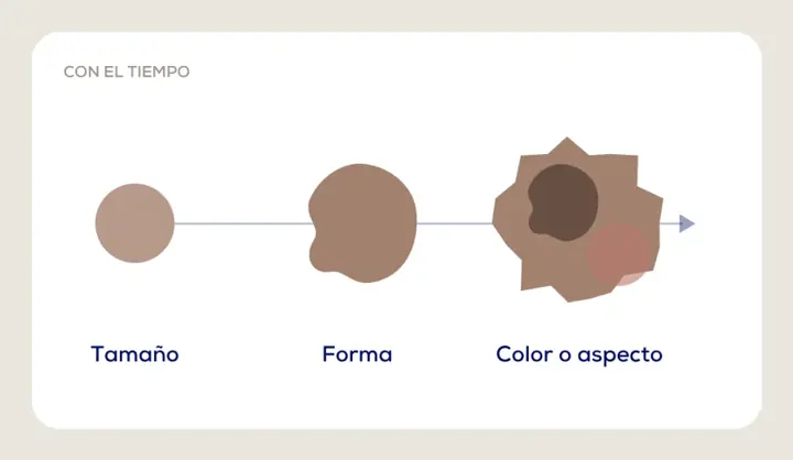 Regla ABCDE: evolución de un lunar en tamaño, forma y color